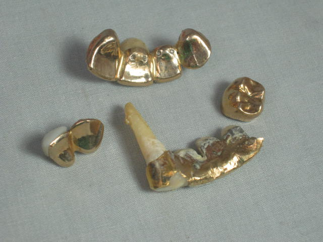 Vtg Columbia Dentoform Dental Mold Form w/Gold Teeth Fillings Bridges Crowns NR! 8